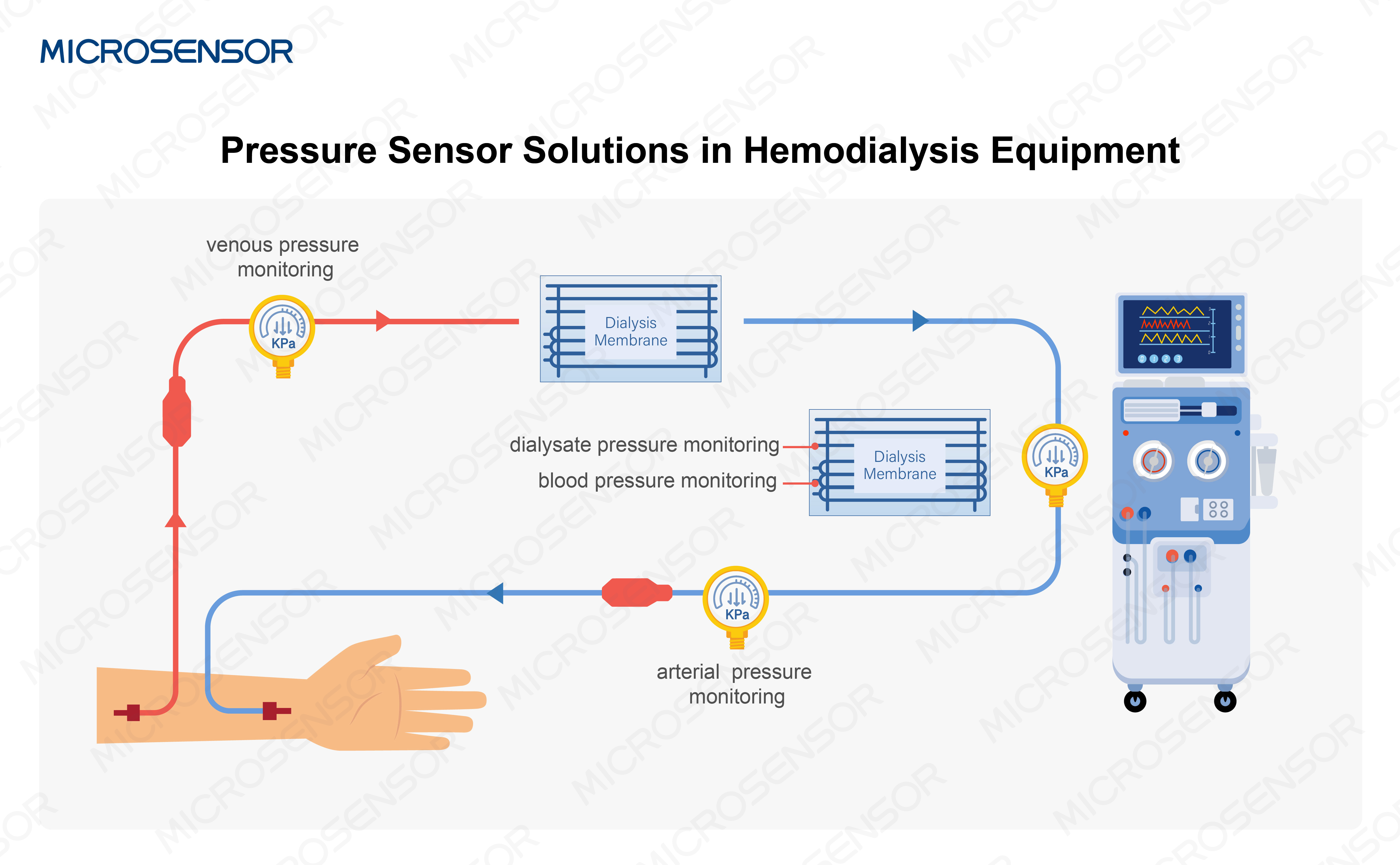 pressure sensor solution in hemodialysis pressure sensor solution in hemodialysis